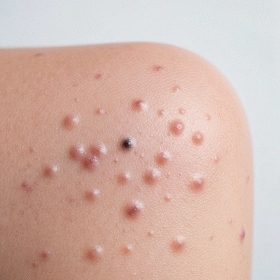 Close-up view of skin with mild acne, showing blackheads and whiteheads on a clean, light background